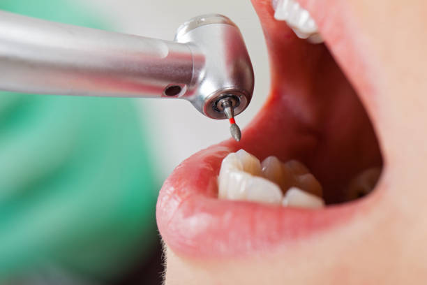 Best Urgent Care for Lost Fillings or Crowns in St Peter, WI